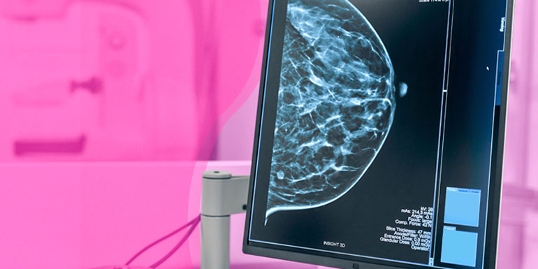 Inibidores de PARP para o tratamento do câncer