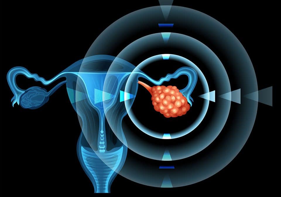 Novo medicamento contra o câncer de ovário atua na correção do DNA em células doentes